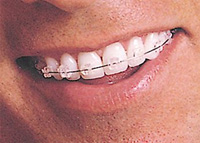 Zahnfarbene Brackets Zahnfarbene Brackets