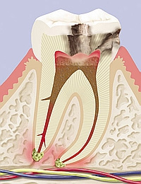Kariös erkrankter Zahn