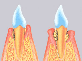 Zahnbett-Erkrankung